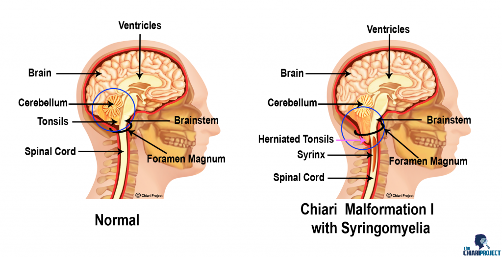 tonsils of cerebellum